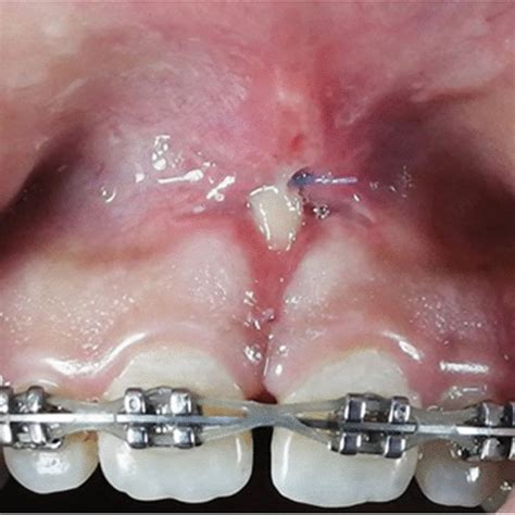 V Shaped Bony Defect And Midline Diastema Between Upper Two Central