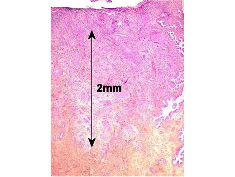 Histopathology Of The Uterine Cervix Digital Atlas