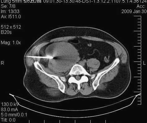 Contribution Of Computed Tomography Guided Percutaneous Drainage Of