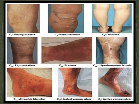 Test For Peripheral Arterial And Venous Circulation