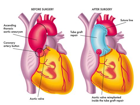 Ascending Aortic Aneurysm - Definition, Diagnosis, Treatment ...