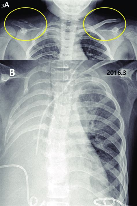 Radiographic findings. (A) Clavicle, both oblique (Sep 2010), vanishing ...