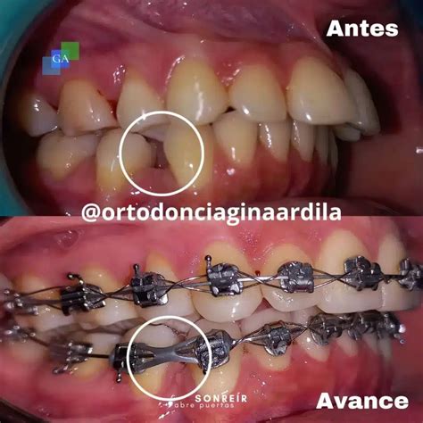 Edad Ideal Para Ponerse Brackets 1 100 Doctora Gina Ardila