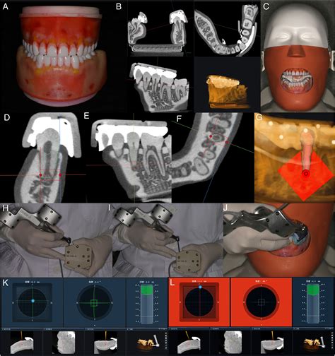 Evaluation Of A Novel Drilling Approach For Dynamic Navigation Aided Endodontic Microsurgery A