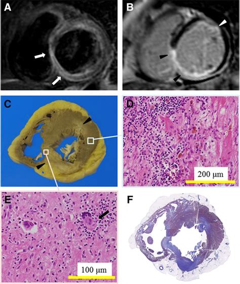 Cardiac Magnetic Resonance Imaging In Giant Cell Myocarditis Circulation