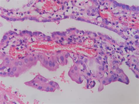 Nephrogenic Metaplasia Histopathologyguru