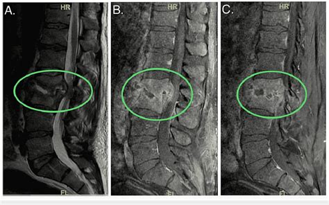 Multi Planar Images From The Initial MRI Showing L2 And L3 Discitis And