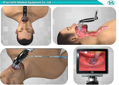 Micro Usb Direct Laryngoscopy Intubation Rigid Video Laryngoscope Resolution 1200 1600px