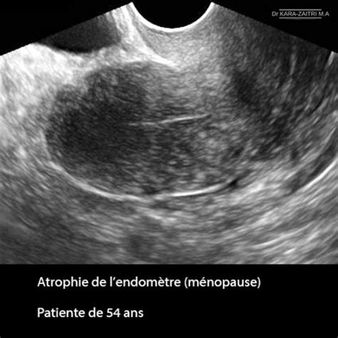 Anomalies De La Cavit Ut Rine Dr Kara Zaitri M A