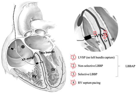 Left Bundle Branch Anatomy