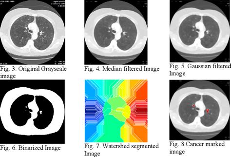 Pdf Lung Cancer Detection Using Ct Scan Images Semantic Scholar