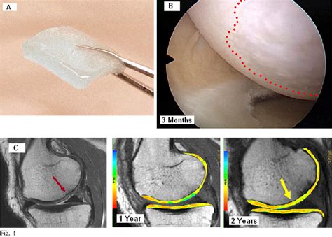 Figure 2 From Management Of Articular Cartilage Defects Of The Knee Semantic Scholar