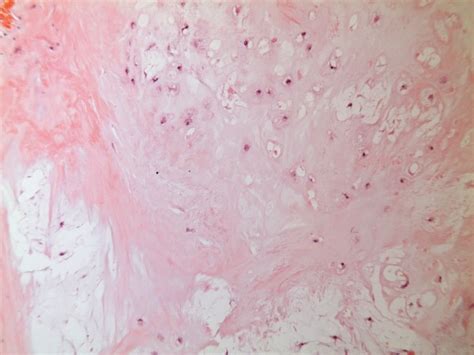 Histopathology Picture Low Power Showing Grade Chondrosarcoma With