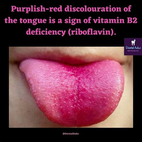 Sign of Vitamin B2 deficiency ⚠️