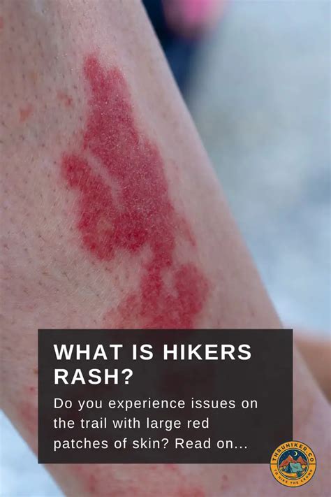 Hiker’s Rash: Problems With Heavy Activity in Hot Weather – Thruhiker