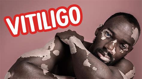 Entenda o que é o vitiligo Tudo Sobre Corpo Humano Patrick