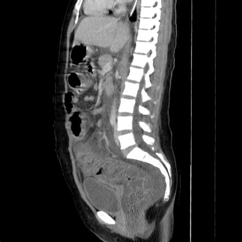 Pseudomembranous Colitis Image Radiopaedia Org