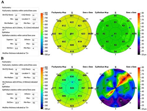 One Patients Right Eye Anterior Segment Optical Coherence Tomography