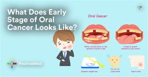 What Do Early Stages Of Oral Cancer Look Like Positivemed | Hot Sex Picture