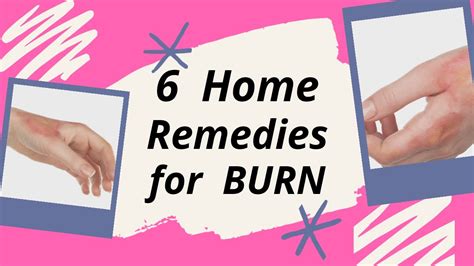 6 Home Remedies For Burn How To Treat Burns At Home How To Treat Burn Skin Home Remedy