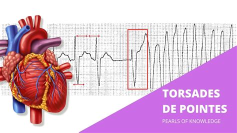 Torsades De Pointes