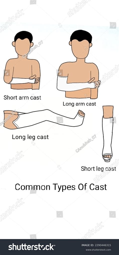 Common Types Cast Nursing Stock Illustration 2290446315 | Shutterstock