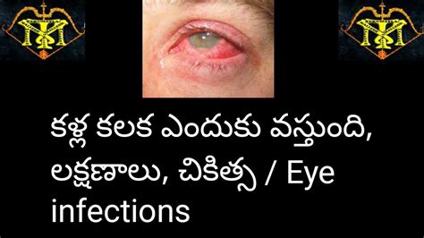 Eye Infections Treatment Youtube