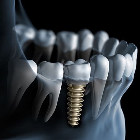 Dental Implants Louisville KY Missing Teeth Dentures