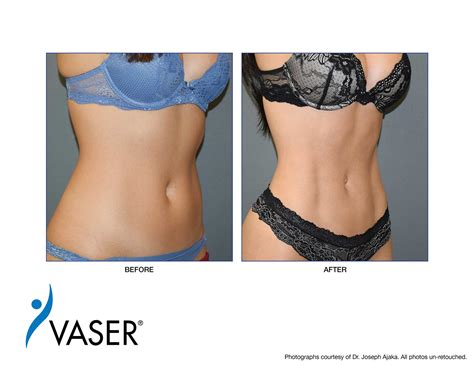 Vaser Liposuction In Chicago Ridge Dr Donkoh Expert Cosmetic Surgeon