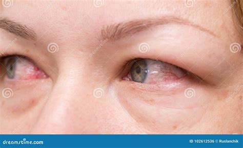 Red eyes stock photo. Image of allergy, infected, medical - 102612536