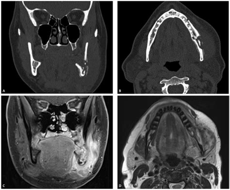 Osteomyelitis Jaw Radiographic Appearance