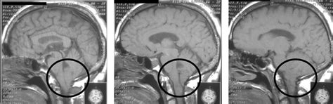 Arnold Chiari Malformation Type I In 52 Years Old Female Patient Download Scientific Diagram