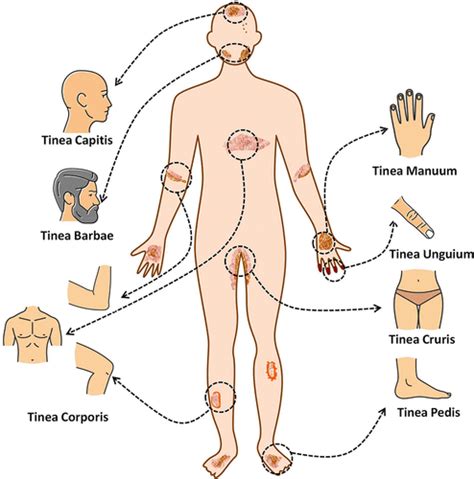 Superficial Dermatophytosis Across The Worlds Populations Potential