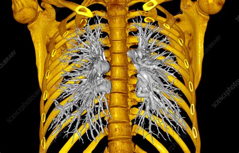 Healthy lungs, CT scan - Stock Image - C057/3457 - Science Photo Library