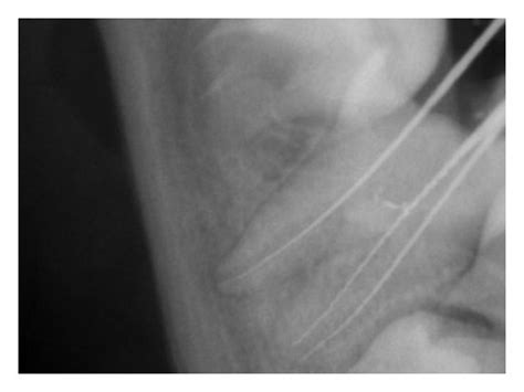 A Preoperative B Working Length Determination C Mta Apical Plug