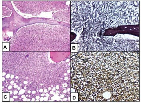 Patterns Of Marrow Involvement In Hl A B Diffuse Pattern A