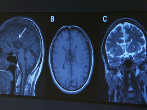 Kids' concussion symptoms can emerge later, linger for weeks - CBS News