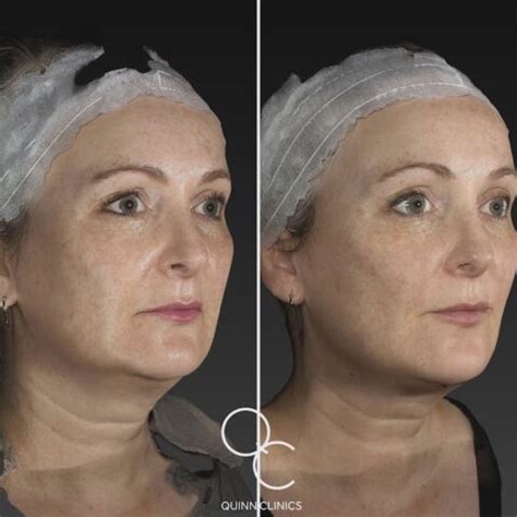 Ultherapy Ultrasound Quinn Clinics Bristol