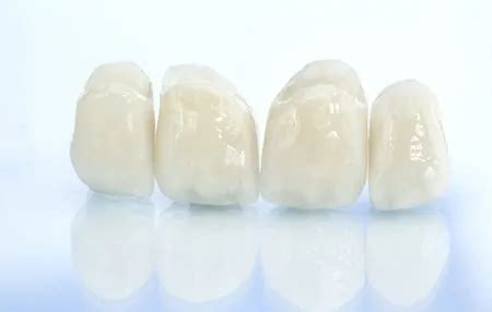 Allon4, Dental Implants, Veneers, Dentures at our Newcastle Dental Clinic