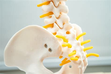 Lumbar Spine Displaced Herniated Disc Fragment, Spinal Nerve and Bone. Model for Treatment ...