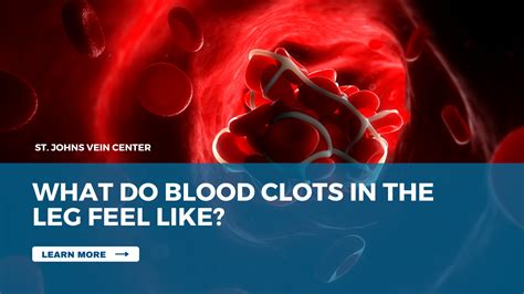 Blood Clots In Legs: Symptoms, Risks and How To Treat Them - St Johns ...