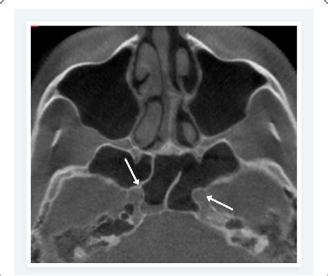 Axial Cbct Scan Showing Bilateral Internal Carotid Artery Protrusion