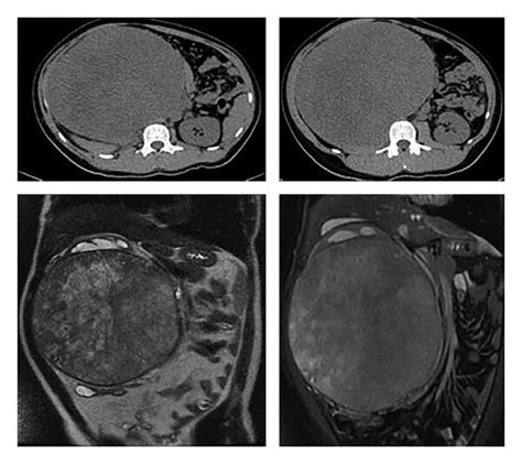 Growing Teratoma Syndrome Scavuzzo 2014 Case Reports In Urology