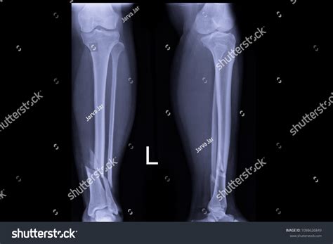 20,637 X ray fracture Images, Stock Photos & Vectors | Shutterstock