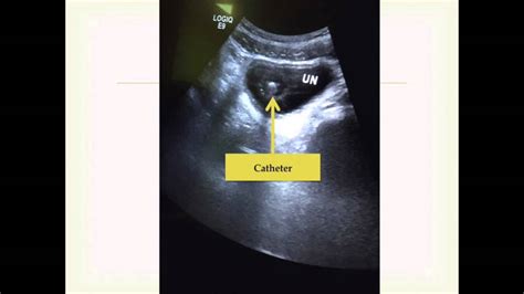 Bladder Catheter Ultrasound