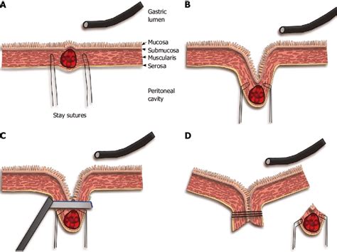 Endoscope Assisted Laparoscopic Wedge Resection A The Tumor Is