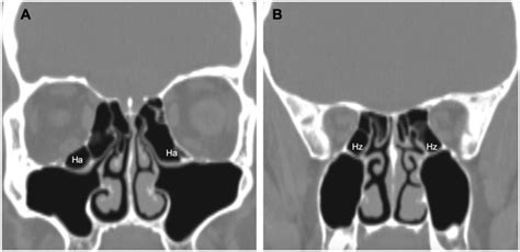 Retromaxillary Pneumatization Of Posterior Ethmoid Air 50 Off