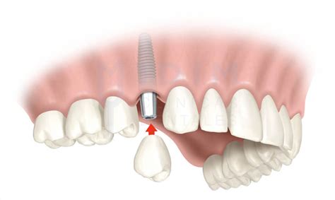 Materiales De Los Implantes All On Dentisalut