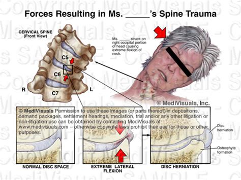 Understanding The Osteophyte Disc Complex In Spinal Trauma