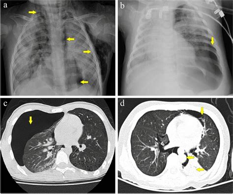 Imaging Presentation A Anteriorposterior Chest Radiograph Of A